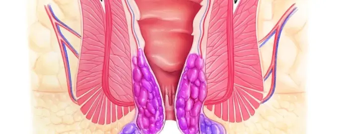 Тромбированный узел геморрой